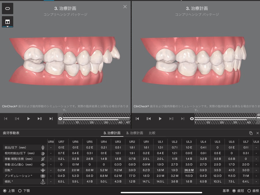 歯並び3Dデータからの歯の移動量・角度の確認