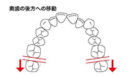 ワイヤー矯正と比べて