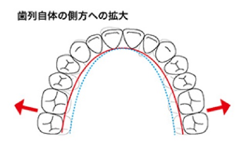 ワイヤー矯正と比べて