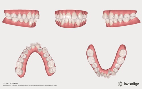 事前シミュレーションで歯並び・顔貌の変化がわかる